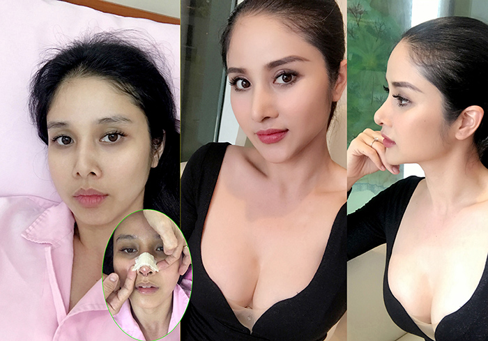 Vợ cũ Phan Thanh Bình tiết lộ lý do nâng ngực, sửa mũi