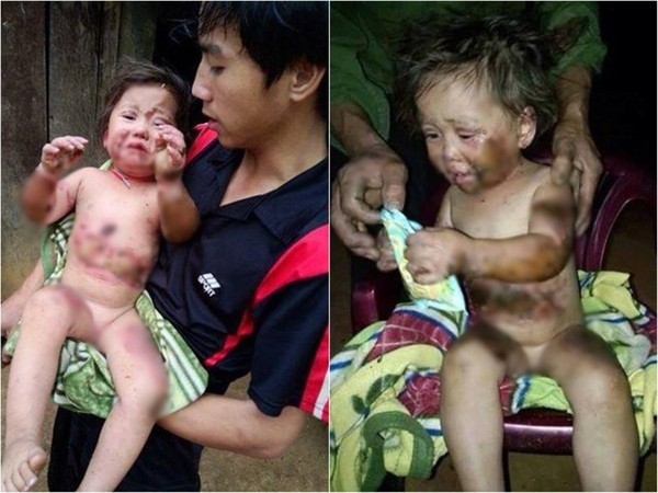 Xót xa bé gái 2 tuổi bị bỏng toàn thân, vết bỏng nhiễm trùng nặng