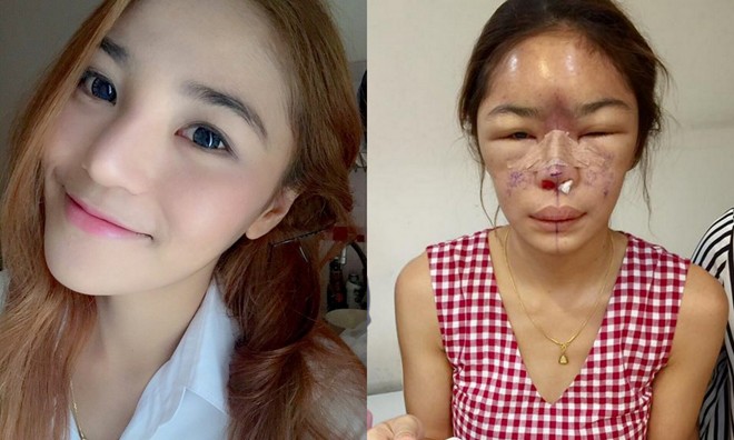 Cô gái bị biến dạng khuôn mặt vì phẫu thuật hỏng