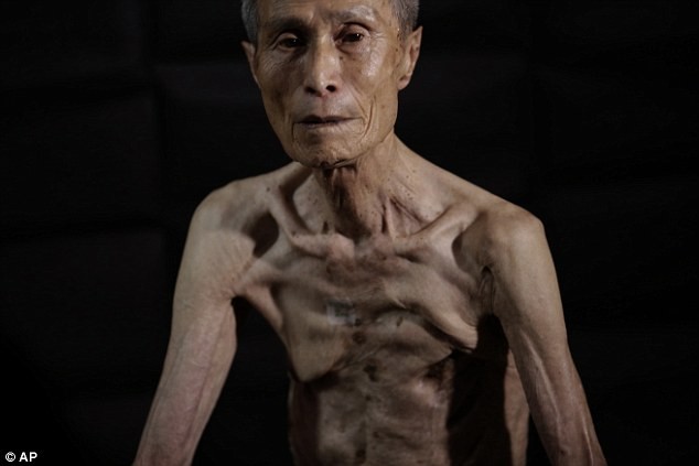 Cơ thể đầy sẹo của nạn nhân bom nguyên tử ở Nhật