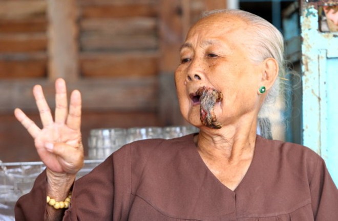 Cụ bà 87 tuổi bị phần thịt dư cả tấc ở miệng