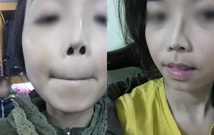 Cô gái Hà Nội bế tắc vì đã 2 lần đau đớn thẩm mỹ nhưng mũi vẫn... lệch