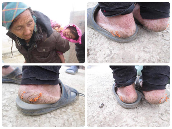 Dân mạng kêu gọi giúp đỡ cụ bà dùng chỉ khâu gót chân