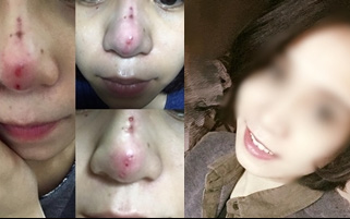 Một cô gái Sài Gòn chia sẻ trải nghiệm khủng khiếp sau khi nâng mũi bằng "chỉ"