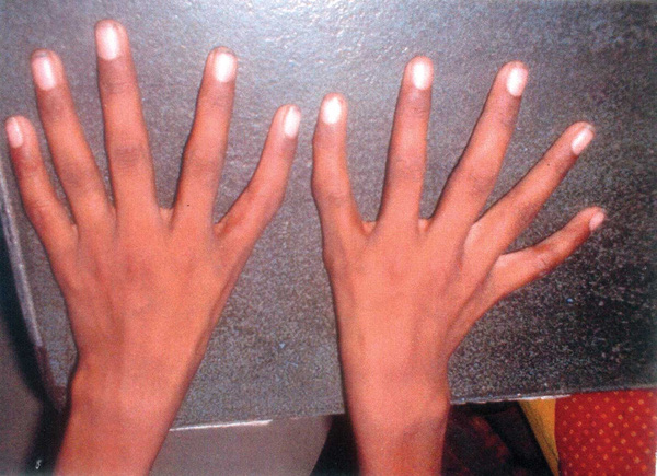 Bí hiểm hội chứng "bàn tay ngoài hành tinh" biến ngón cái thành... ngón trỏ