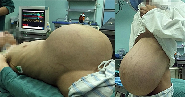 Người đàn ông "mang bầu" khối u 12,7kg hơn 10 năm