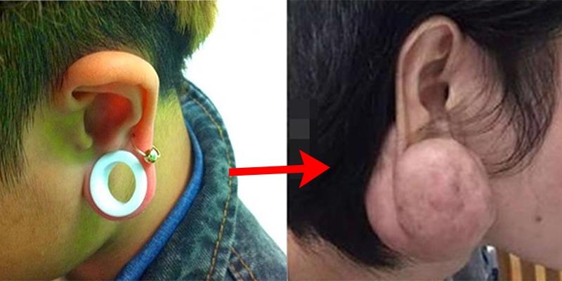Xỏ khuyên tai không đúng cách có thể gây hại đến mức này