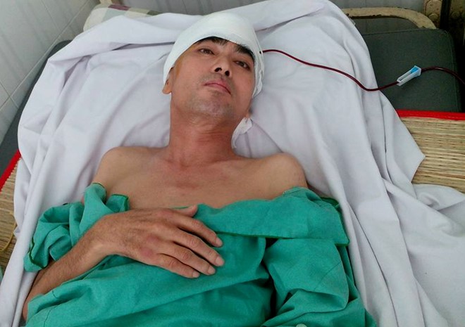 Diễn viên Nguyễn Hoàng phẫu thuật ghép hộp sọ thành công