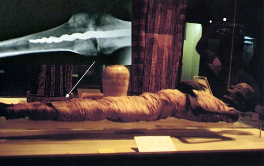 Phát hiện ca ghép cơ thể từ 3000 năm trước