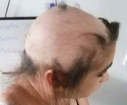 Cô gái bị rụng gần hết tóc vì thất tình