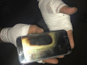 Một người đàn ông bị bỏng khá nặng do Galaxy S7 phát nổ trên tay