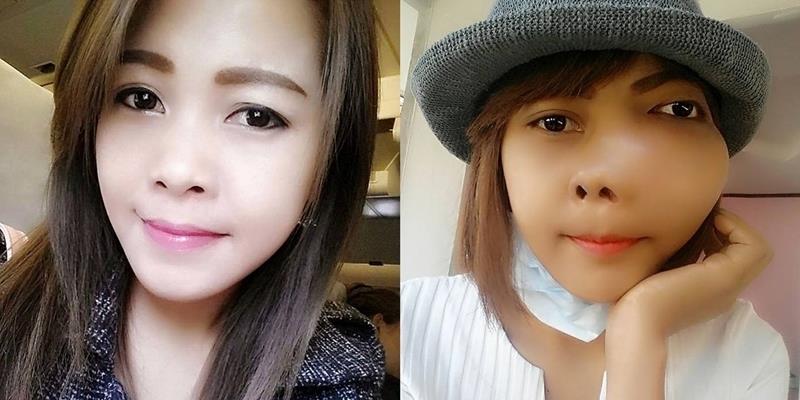 Mỹ nữ Thái gây sốc với gương mặt dị dạng vì ung thư xương