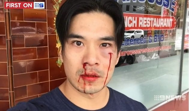 Diễn viên gốc Việt bị đánh mẻ răng, chảy máu mũi ở Australia