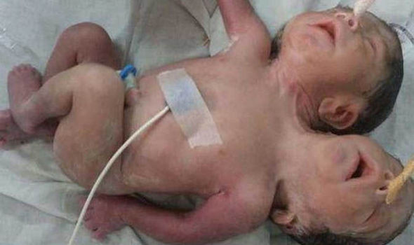 Em bé 2 đầu, 3 cánh tay ra đời ở Ấn Độ