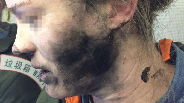 Một phụ nữ bị cháy mặt vì tai nghe phát nổ trên máy bay