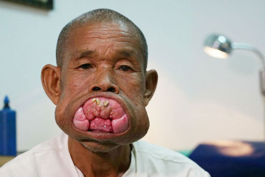 Cụ ông Campuchia sau ca phẫu thuật bộ nướu răng khổng lồ