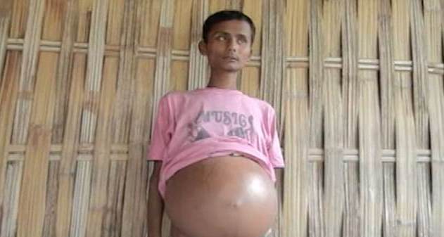 Chàng trai 21 tuổi vật vã với bụng tròn căng như bà bầu đến ngày sinh nở