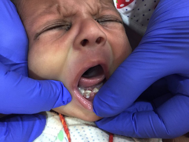 Em bé đầu tiên trên thế giới mới lọt lòng mẹ đã có 7 răng