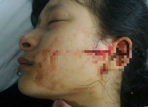 Nữ sinh lớp 11 bị đâm rách mặt vì mâu thuẫn ở chợ