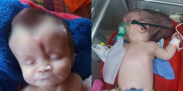 Câu chuyện bé gái 2 tháng tuổi sinh ra bị mất hộp sọ xúc động