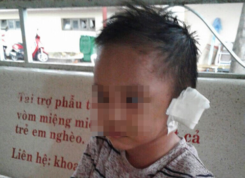 Bé 3 tuổi nghi bị mẹ và 'cha dượng' bạo hành