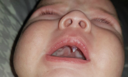 Răng nanh nhọn hoắt trong miệng bé 11 tuần tuổi