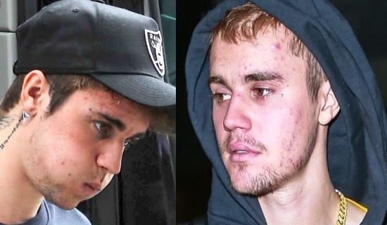 Vì sao Justin Bieber ngày càng tiều tụy, xuống dốc ngoại hình?