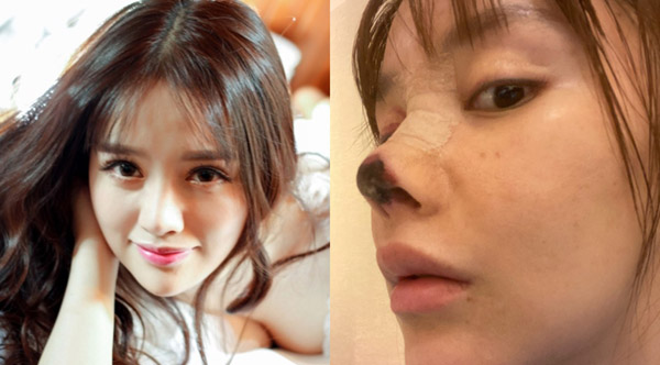 Nữ diễn viên Trung Quốc bị hoại tử mũi do phẫu thuật thẩm mỹ