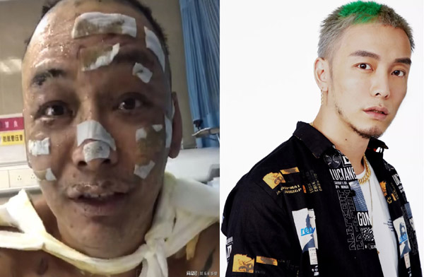 Nam rapper Trung Quốc bị bỏng nặng sau vụ cháy nhà