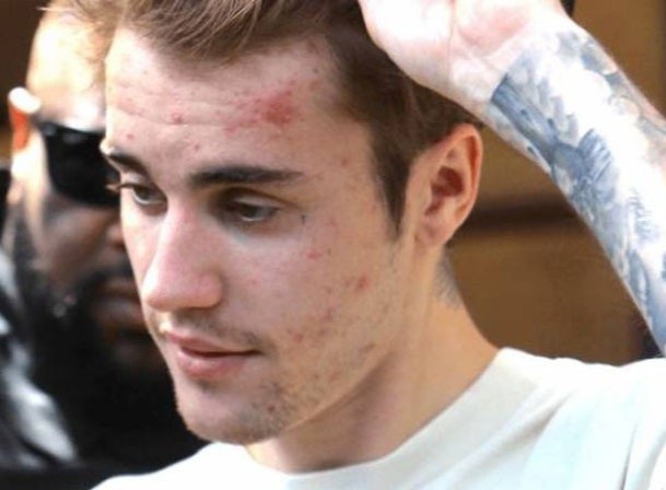 Justin Bieber: 'Tôi bị bệnh ảnh hưởng tới não và da'