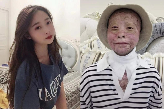 Nghị lực sống của cô gái Trung Quốc sau tai nạn xe hơi