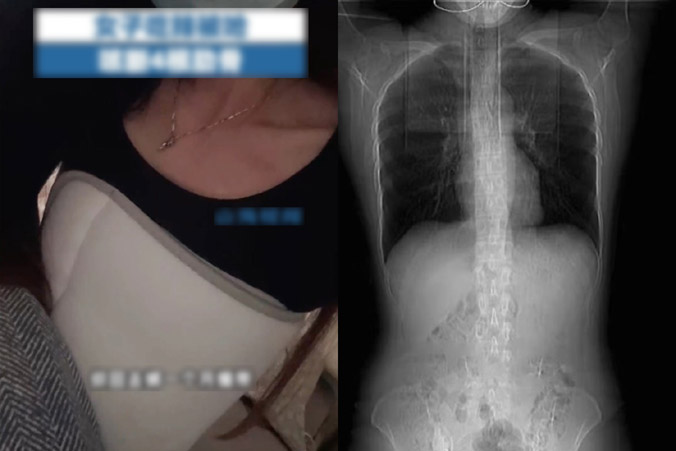 Cô gái Trung Quốc bị gãy xương sườn sau bữa ăn cay
